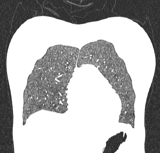 Acute hypersensitivity pneumonitis (Radiopaedia 85293-100870 Coronal lung window 18).jpg