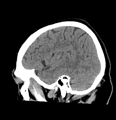 Acute internal carotid artery dissection (Radiopaedia 53541-59558 Sagittal non-contrast 49).jpg