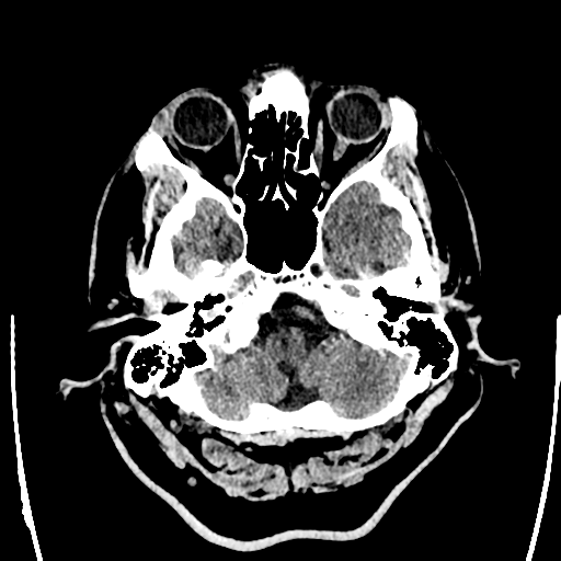 Acute left middle cerebral artery territory ischemic stroke (Radiopaedia 35688-37223 Axial non-contrast 10).png