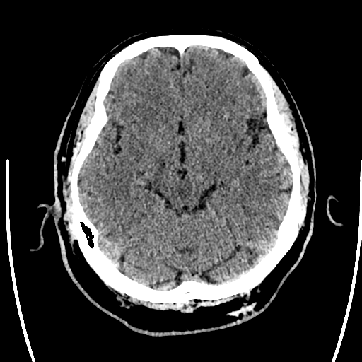 Acute left middle cerebral artery territory ischemic stroke (Radiopaedia 35688-37223 Axial non-contrast 30).png