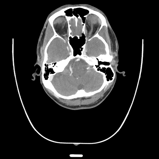 Acute longus colli calcific tendinitis (Radiopaedia 72495-83036 Axial C+ arterial phase 2).jpg