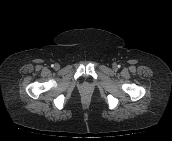 Acute mesenteric ischemia (Radiopaedia 80029-93316 Axial C+ arterial phase 138).jpg