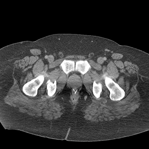Acute mesenteric venous ischemia (Radiopaedia 46041-50383 Axial C+ portal venous phase 145).jpg