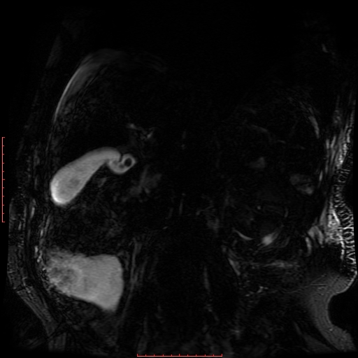 Acute necrotizing pancreatitis (Radiopaedia 28194-28448 Coronal MRCP 24).jpg