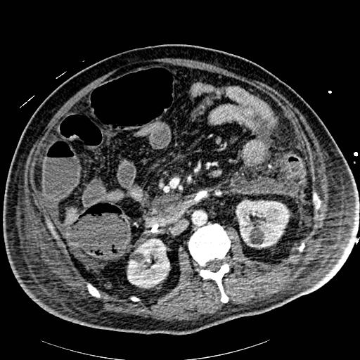 Acute pancreatic necrosis (Radiopaedia 13560-18502 Axial C+ portal venous phase 47).jpg