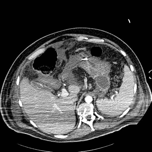 Acute pancreatic necrosis (Radiopaedia 13560-18502 Axial C+ portal venous phase 9).jpg