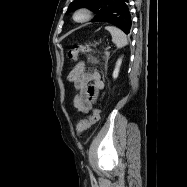 Acute pancreatitis (Radiopaedia 26663-26813 Sagittal C+ portal venous phase 59).jpg