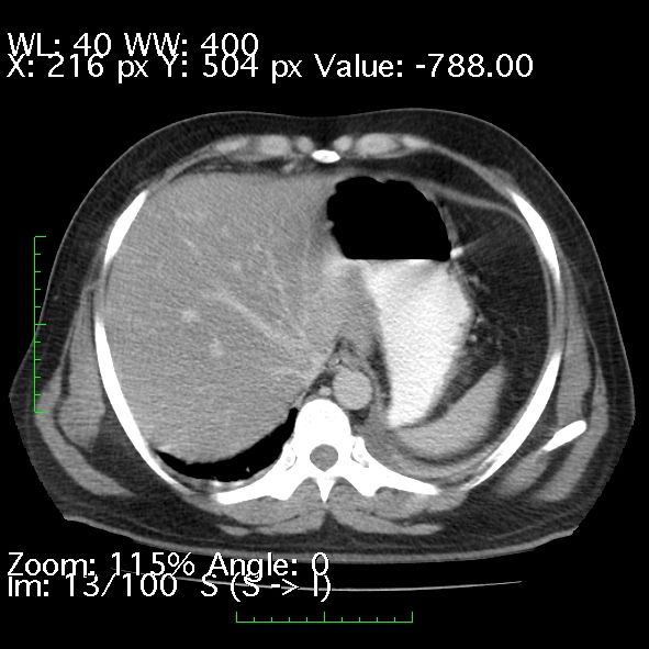 File:Acute pancreatitis (Radiopaedia 34043-35276 Axial C+ portal venous phase 13).jpg