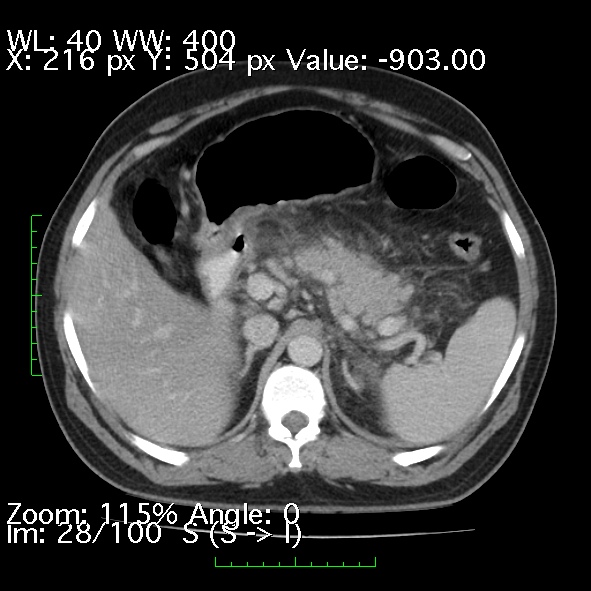 Acute pancreatitis (Radiopaedia 34043-35276 Axial C+ portal venous phase 28).jpg