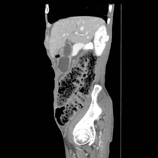 File:Acute pancreatitis (Radiopaedia 50213-55558 Sagittal C+ portal venous phase 9).jpg