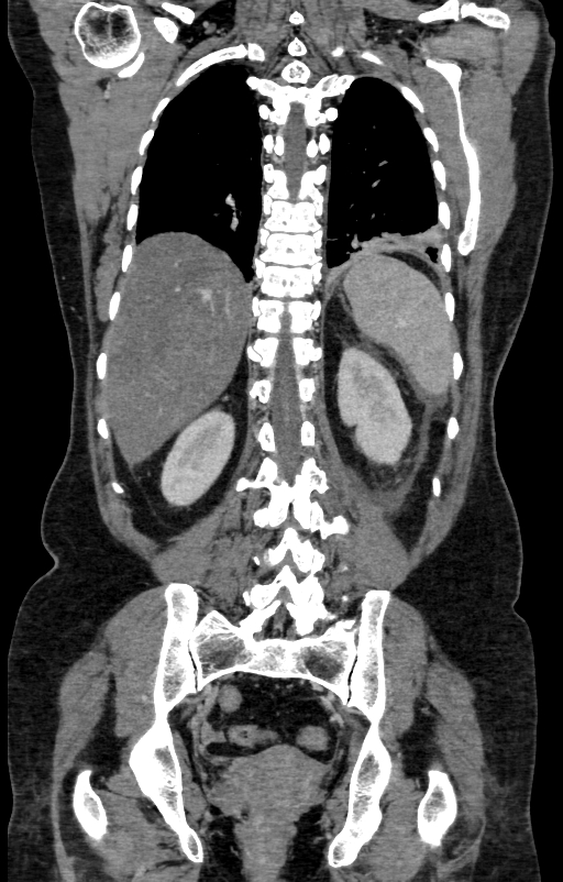 Acute pancreatitis (Radiopaedia 80007-93285 Coronal C+ portal venous phase 125).jpg