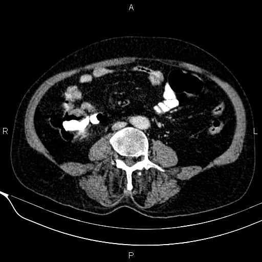 Acute pancreatitis (Radiopaedia 85146-100701 Axial C+ portal venous phase 41).jpg