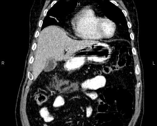Acute pancreatitis (Radiopaedia 85146-100701 Coronal C+ portal venous phase 16).jpg