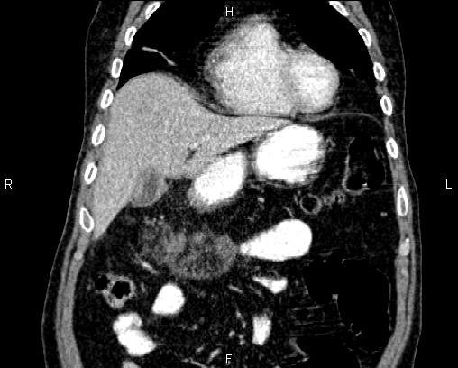 Acute pancreatitis (Radiopaedia 85146-100701 Coronal C+ portal venous phase 17).jpg