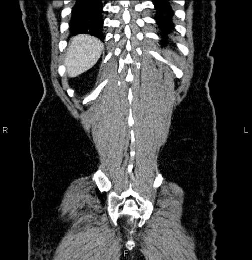 Acute pancreatitis (Radiopaedia 85390-101010 Coronal C+ portal venous phase 66).jpg