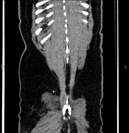 File:Acute pancreatitis (Radiopaedia 85390-101010 Coronal C+ portal venous phase 70).jpg