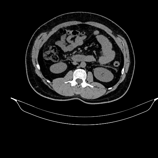 File:Acute pancreatitis (Radiopaedia 87428-103757 Axial non-contrast 47).jpg