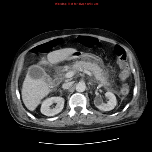 File:Acute pancreatitis with incidental pancreatic lipoma (Radiopaedia 10190-10730 Axial C+ portal venous phase 24).jpg