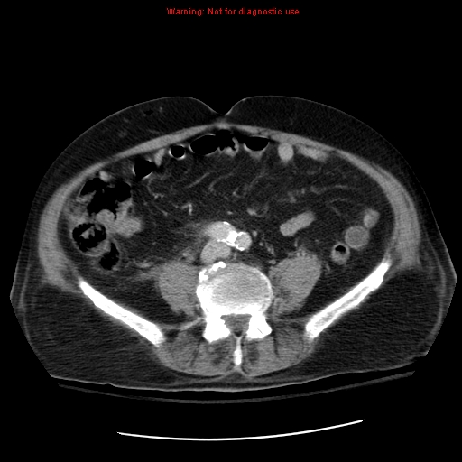 File:Acute pancreatitis with incidental pancreatic lipoma (Radiopaedia 10190-10730 Axial C+ portal venous phase 50).jpg