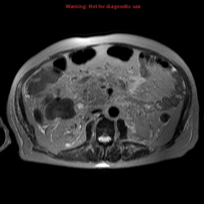 File:Acute pancreatitis with incidental pancreatic lipoma (Radiopaedia 10190-10732 Axial T2 4).jpg