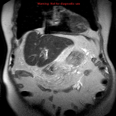 File:Acute pancreatitis with incidental pancreatic lipoma (Radiopaedia 10190-10732 Coronal T2 8).jpg