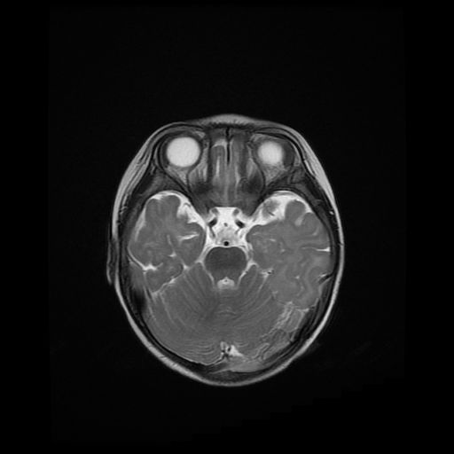 File:Acute phase of hemiconvulsion-hemiplegia epilepsy syndrome (Radiopaedia 29309-29745 Axial T2 16).jpg