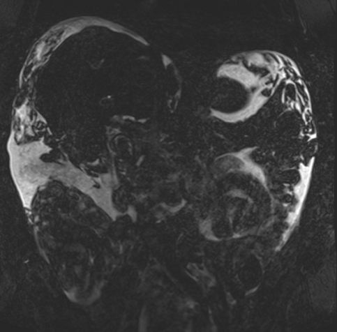 Acute portal vein thrombosis (Radiopaedia 73198-83925 Coronal Heavily T2 thin cuts 39).jpg