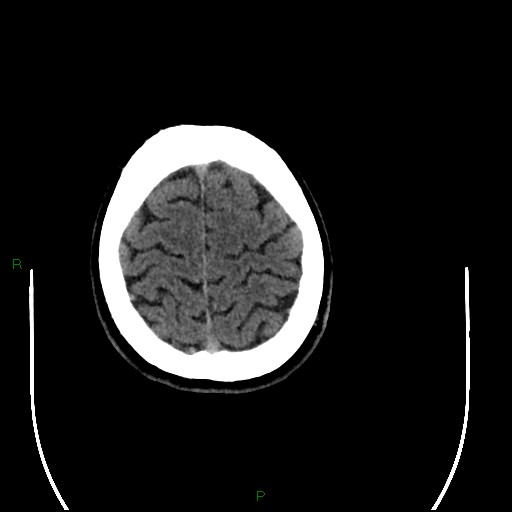 Acute posterior cerebral artery territory infarct (Radiopaedia 79329-92393 Axial non-contrast 97).jpg