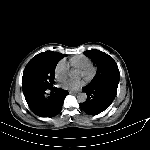 File:Acute pulmonary embolism (Radiopaedia 69510-79390 Axial non-contrast 31).jpg