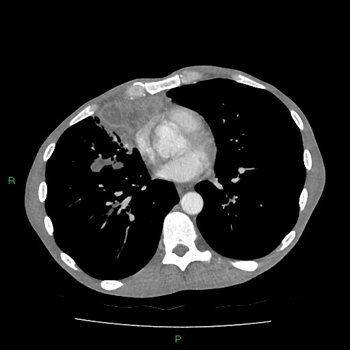 File:Acute right lung abscess (Radiopaedia 34806-36258 Axial C+ arterial phase 116).jpg