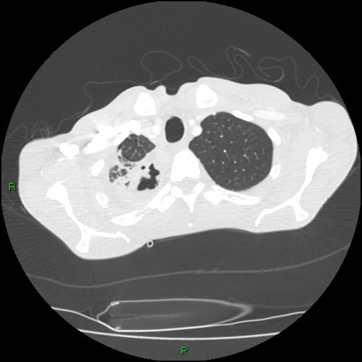 Acute right lung abscess (Radiopaedia 34806-36258 Axial lung window 23).jpg