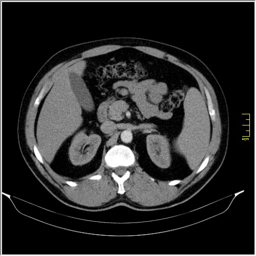 File:Acute right sided diverticulitis (Radiopaedia 65249-74268 Axial C+ portal venous phase 25).JPG