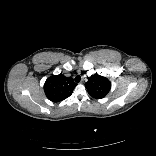 Acute segmental pulmonary emboli and pulmonary infarction (Radiopaedia 62264-70444 Axial C+ CTPA 25).jpg