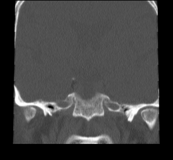 File:Acute sinusitis (Radiopaedia 23161-23215 Coronal bone window 59).jpg