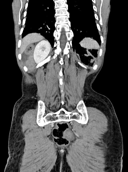 Acute small bowel (ileal) volvulus (Radiopaedia 71740-82139 Coronal C+ portal venous phase 93).jpg