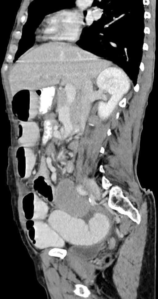 Acute small bowel (ileal) volvulus (Radiopaedia 71740-82139 Sagittal C+ portal venous phase 102).jpg