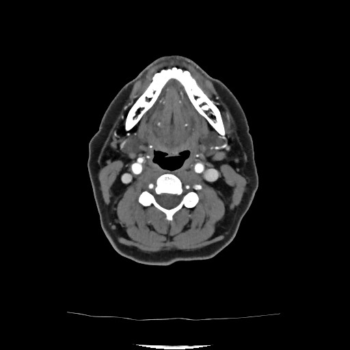 Acute subarachnoid hemorrhage and accessory anterior cerebral artery (Radiopaedia 69231-79009 Axial C+ arterial phase 55).jpg