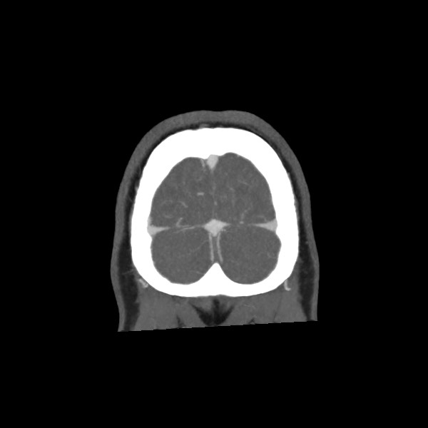 Acute subarachnoid hemorrhage and accessory anterior cerebral artery (Radiopaedia 69231-79009 Coronal C+ arterial phase 75).jpg