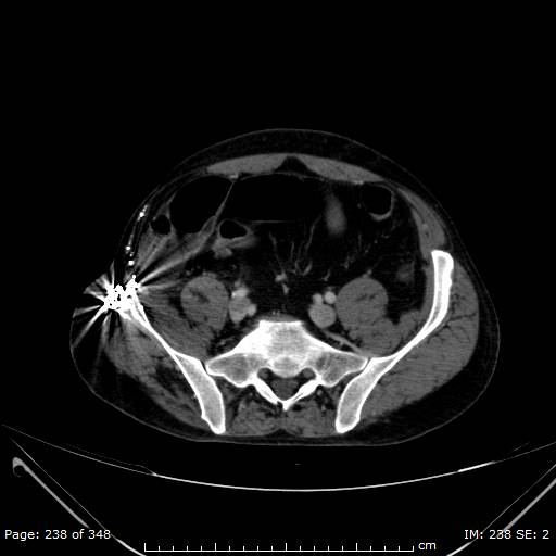 Acute superior mesenteric artery occlusion (Radiopaedia 43636-47060 Axial C+ portal venous phase 44).jpg