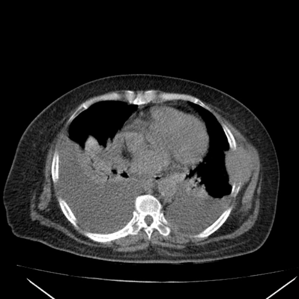 Acute tubular necrosis (Radiopaedia 28077-28334 Axial non-contrast 3).jpg