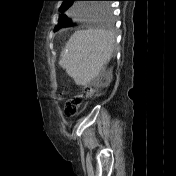 Acute tubular necrosis (Radiopaedia 28077-28334 H 18).jpg