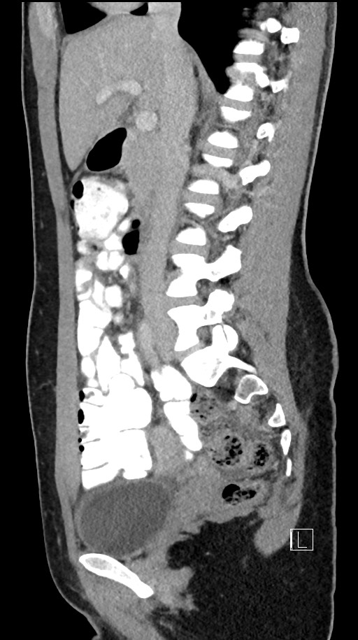 Acute uncomplicated appendicitis (Radiopaedia 61374-69304 Sagittal C+ portal venous phase 58).jpg