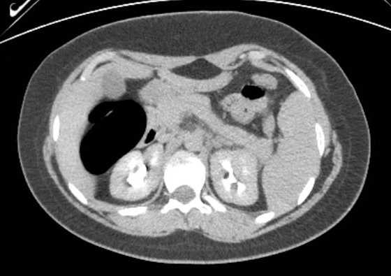 File:Acute unilateral nonhemorrhagic adrenal infarction (Radiopaedia 67560-76957 Axial renal excretory phase 45).jpg