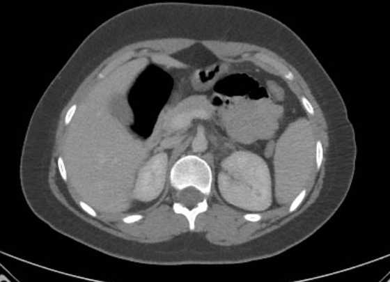 Acute unilateral nonhemorrhagic adrenal infarction (Radiopaedia 67560-76957 Axial renal parenchymal phase 46).jpg