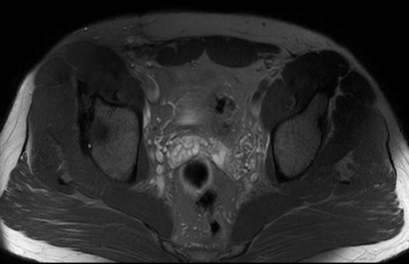 File:Adductor longus tear with retraction (Radiopaedia 56424-63103 Axial T2 fat sat 7).jpg