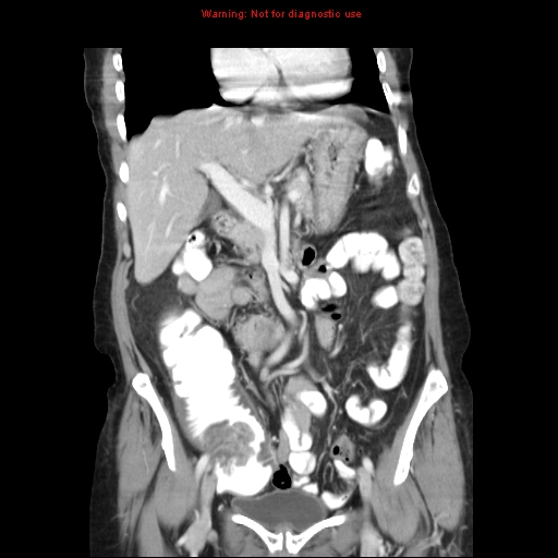 File:Adenocarcinoma of the colon (Radiopaedia 8191-9039 Coronal liver window 19).jpg
