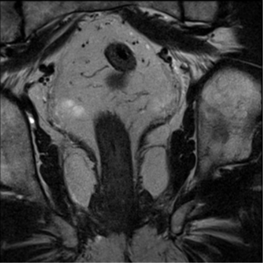 File:Adenocarcioma of rectum- T1 lesion (Radiopaedia 36921-38546 Coronal T2 12).png