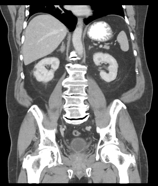 Adenocarcioma of rectum- T1 lesion (Radiopaedia 36921-38547 Coronal C+ portal venous phase 39).png
