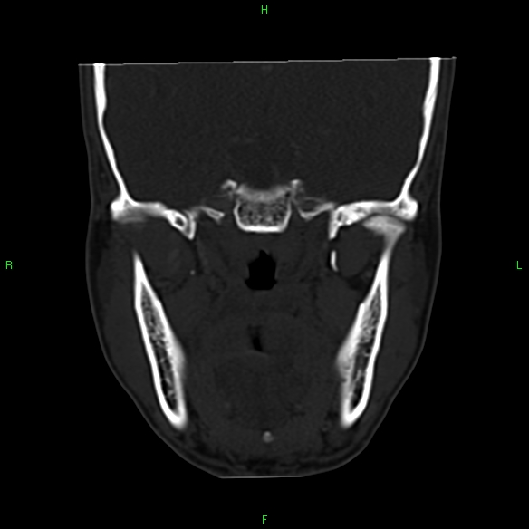 File:Adenoid cystic carcinoma of hard palate (Radiopaedia 26137-26273 Coronal bone window 19).jpg