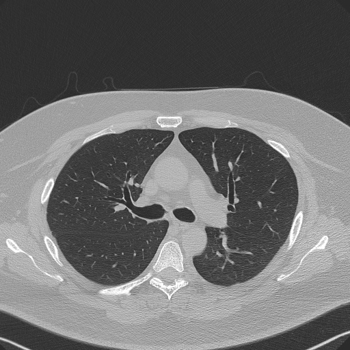 Adenoid cystic carcinoma of the trachea (Radiopaedia 49042-54137 Axial lung window 133).jpg